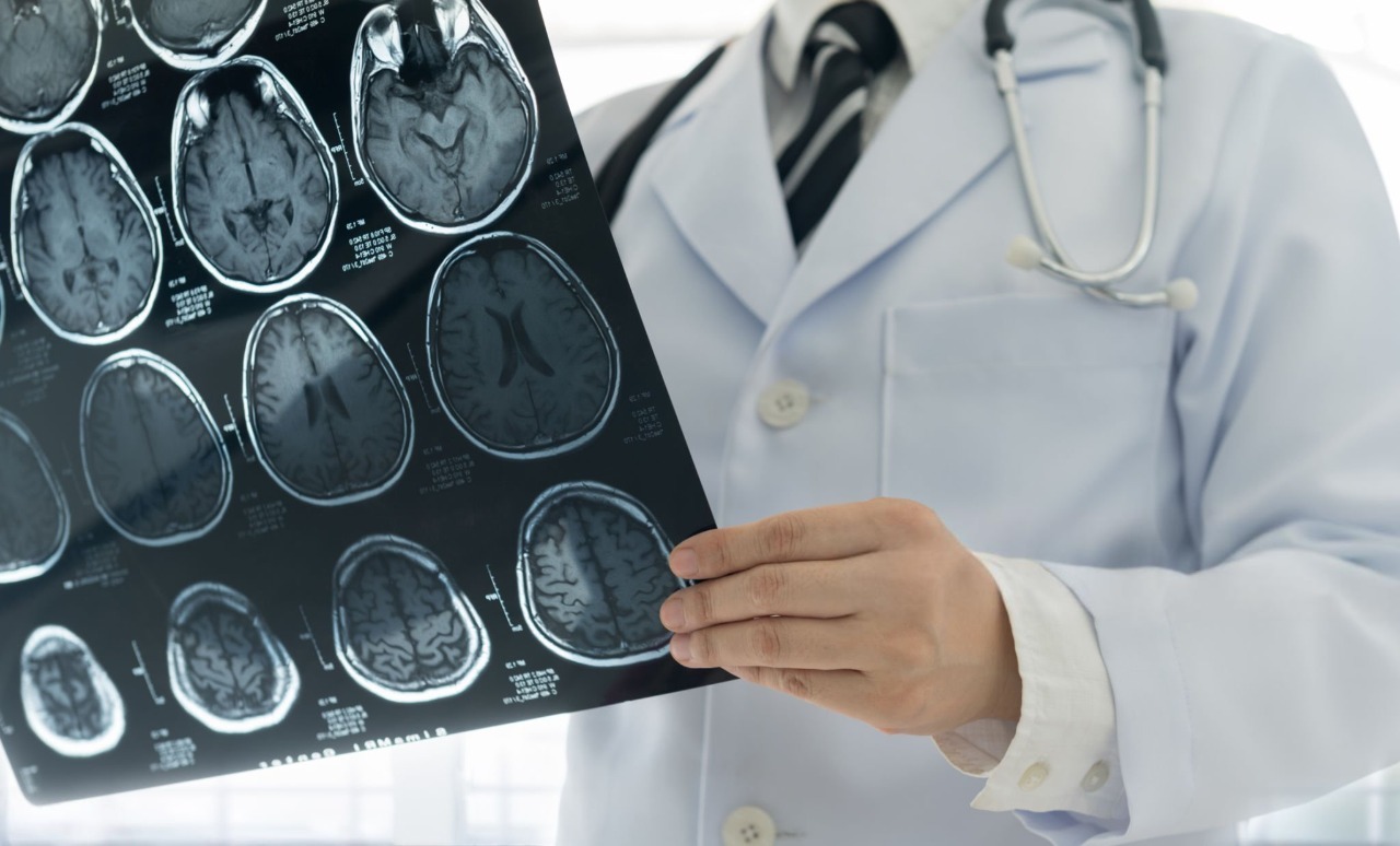 CT Head Scans in Stroke